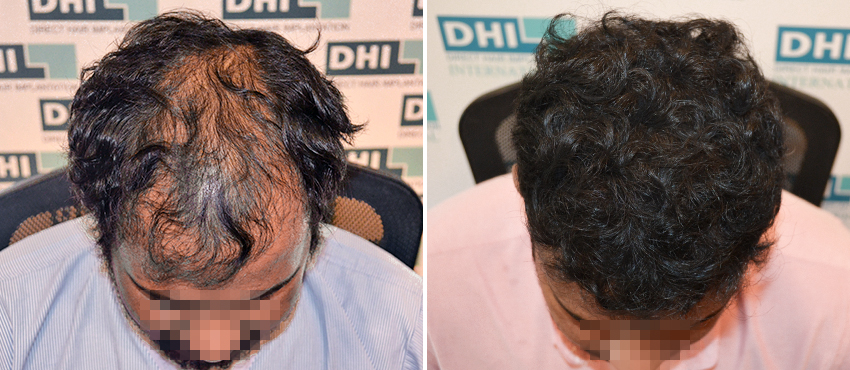 DHI before & after hair transplant results